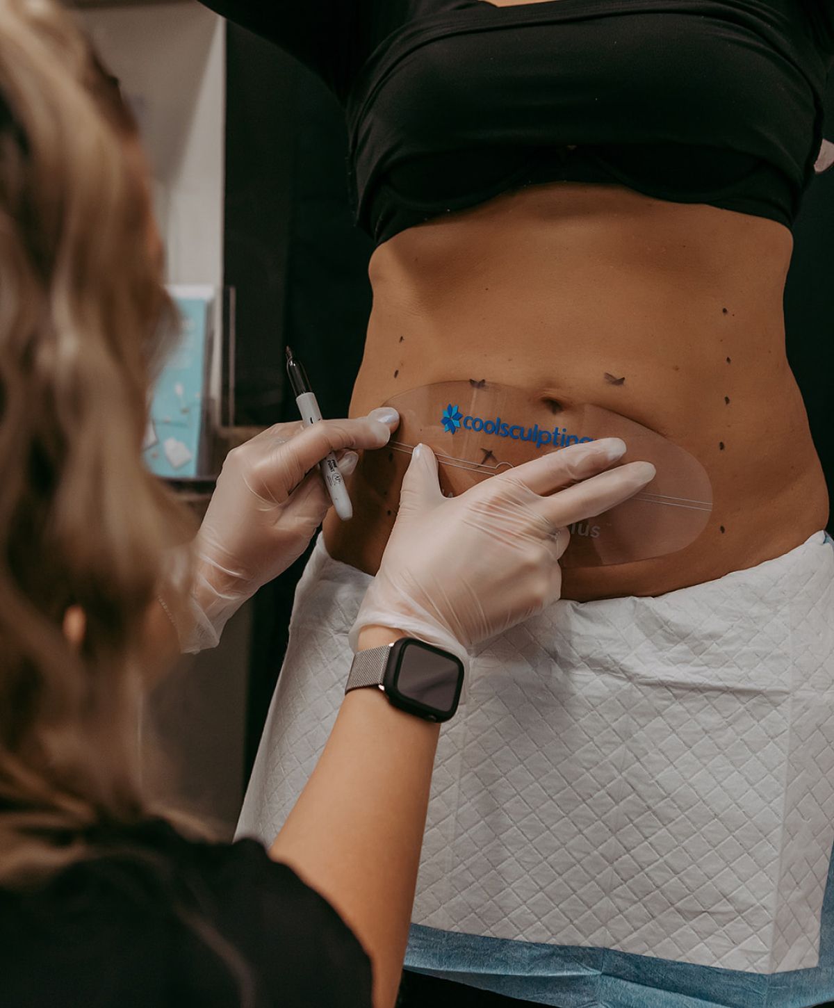 Preparing for a CoolSculpting procedure on abdomen.