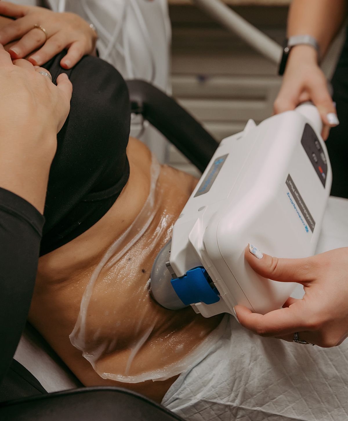 CoolSculpting treatment on a person's abdomen.